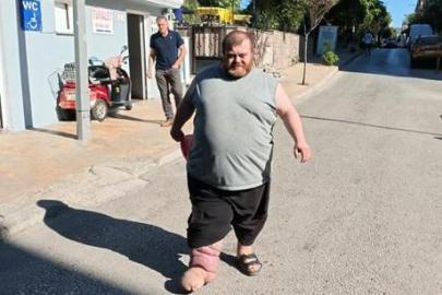 4 yıldır fil hastalığıyla mücadele ediyor! Yürümek için 82 kilo vermesi gerekiyor
